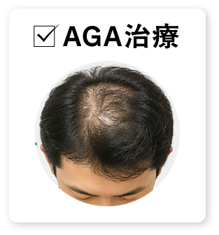 AGA治療